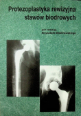 Protezoplastyka rewizyjna stawów biodrowych
