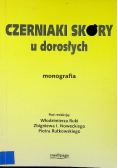Czerniak skóry u dorosłych