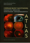 Czerniak błony naczyniowej Diagnostyka różnicowa nowotworów wewnątrzgałkowych