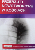 Przerzuty nowotworowe w kościach
