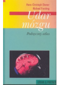 Udar mózgu