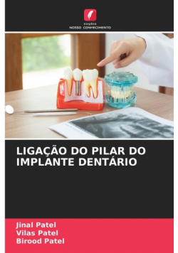 Ligação Do Pilar Do Implante Dentário