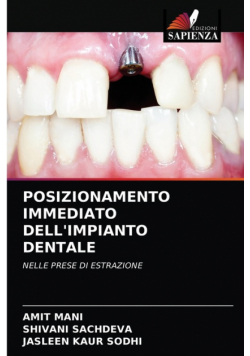 Posizionamento Immediato Dell'impianto Dentale