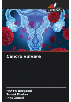Cancro vulvare