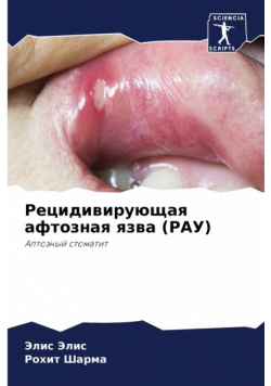 Рецидивирующая афтозная язва (РАУ)