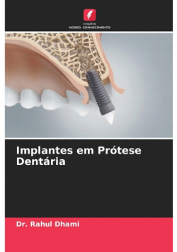 Implantes em Prótese Dentária