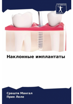 Наклонные имплантаты