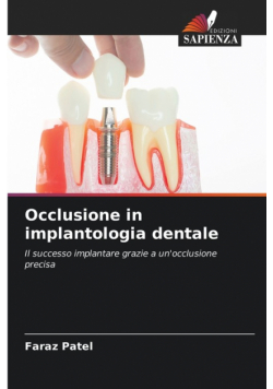 Occlusione in implantologia dentale