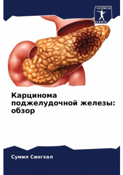 Карцинома поджелудочной железы