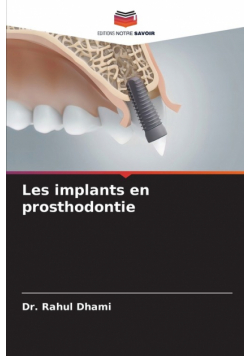 Les implants en prosthodontie