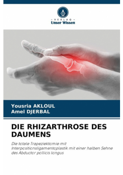 Die Rhizarthrose Des Daumens