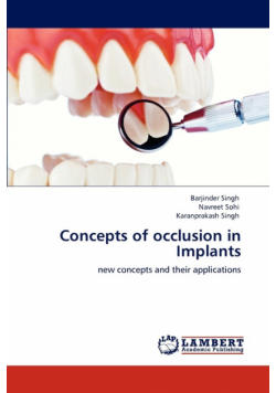 Concepts of occlusion in Implants