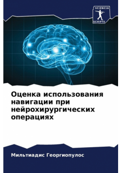 Оценка использования навигации при нейрохирургических операциях