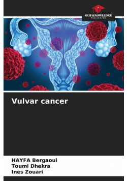 Vulvar cancer