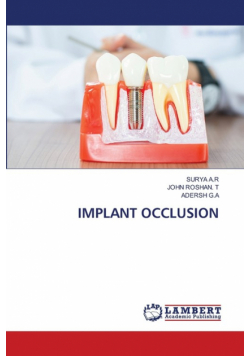 Implant Occlusion
