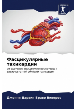 Фасцикулярные тахикардии