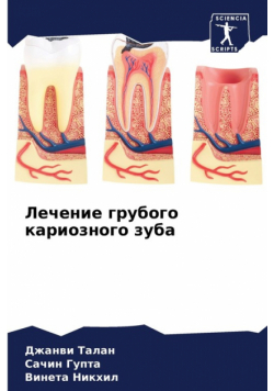 Лечение грубого кариозного зуба
