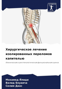 Хирургическое лечение изолированных переломов капителью