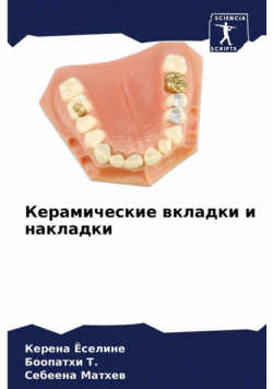 Керамические вкладки и накладки