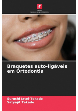Braquetes auto-ligáveis em Ortodontia