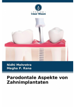 Parodontale Aspekte von Zahnimplantaten