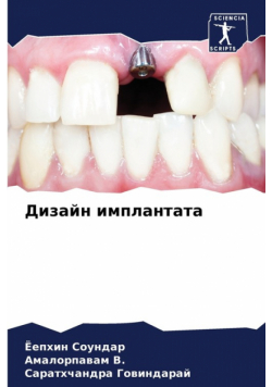 Дизайн имплантата