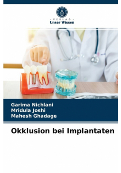 Okklusion bei Implantaten
