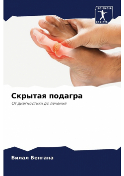 Скрытая подагра