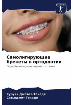 Самолигирующие брекеты в ортодонтии