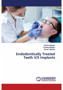 Endodontically Treated Teeth V/S Implants