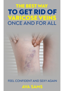 The Best Way to Get Rid of Varicose Veins Once and For All