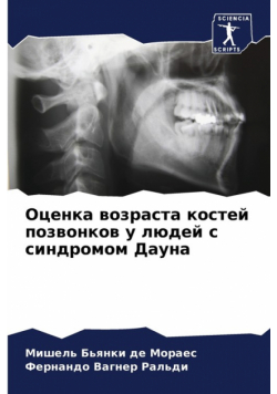 Оценка возраста костей позвонков у людей с синдромом Дауна