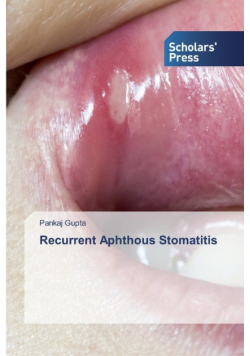 Recurrent Aphthous Stomatitis