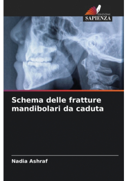 Schema delle fratture mandibolari da caduta