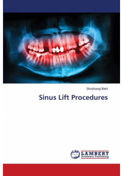 Sinus Lift Procedures