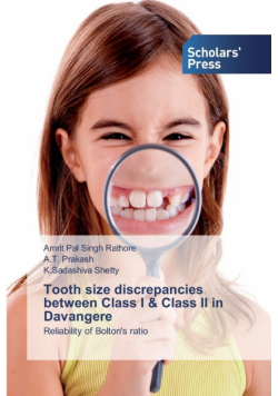 Tooth size discrepancies between Class I & Class II in Davangere