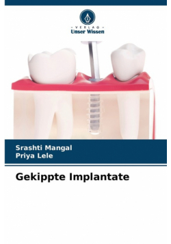 Gekippte Implantate