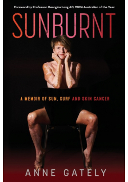 Sunburnt