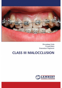 Class Iii Malocclusion