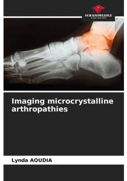 Imaging microcrystalline arthropathies
