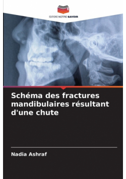 Schéma des fractures mandibulaires résultant d'une chute