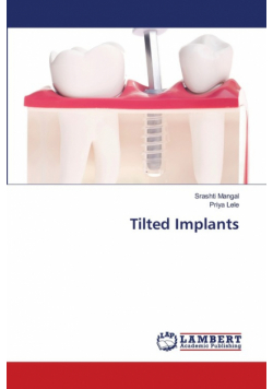 Tilted Implants