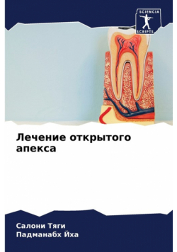 Лечение открытого апекса