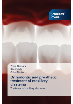 Orthodontic and prosthetic treatment of maxillary diastema