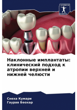 Наклонные имплантаты