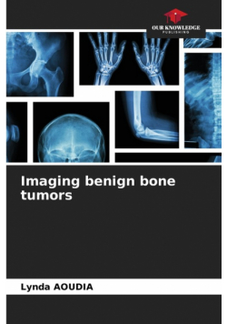 Imaging benign bone tumors
