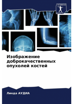 Изображение доброкачественных опухолей костей