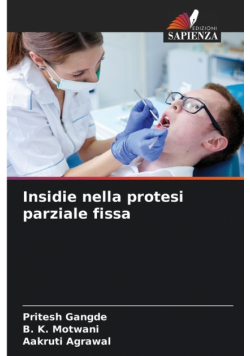 Insidie nella protesi parziale fissa