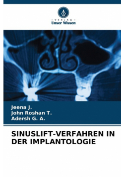Sinuslift-Verfahren In Der Implantologie