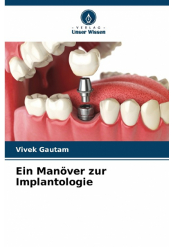 Ein Manöver zur Implantologie